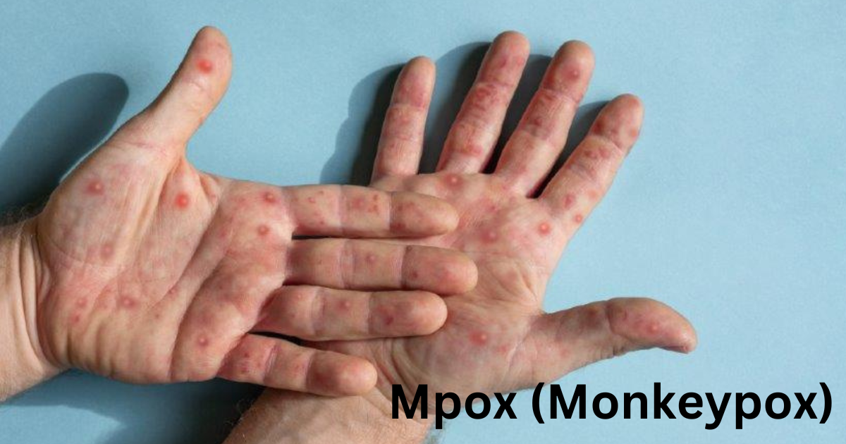 Mpox (Monkeypox)